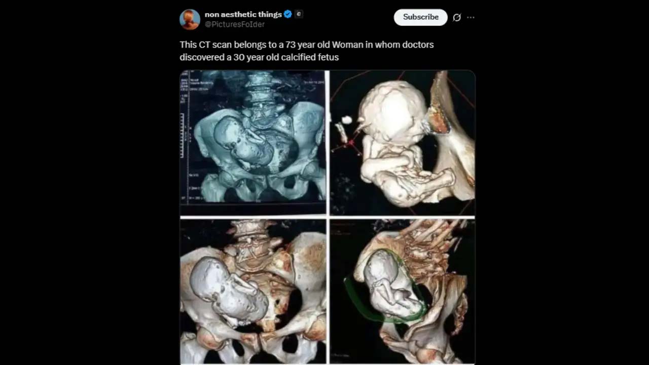 old-calcified-fetus.jpg