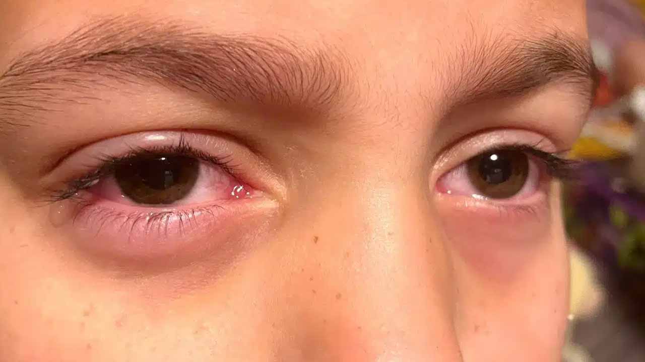 Conjunctivitis.jpg